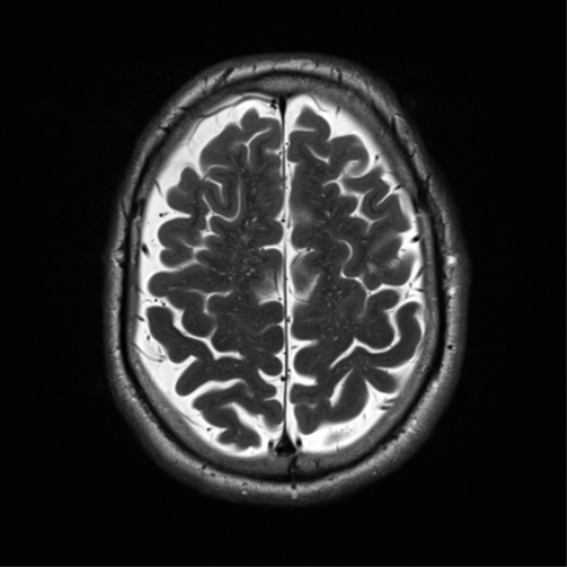 File:Cerebral amyloid angiopathy (Radiopaedia 46082-50433 Axial T2 29).png
