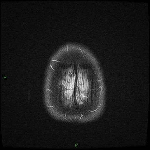 File:Cerebral amyloid angiopathy (Radiopaedia 77506-89664 Axial FLAIR 27).jpg