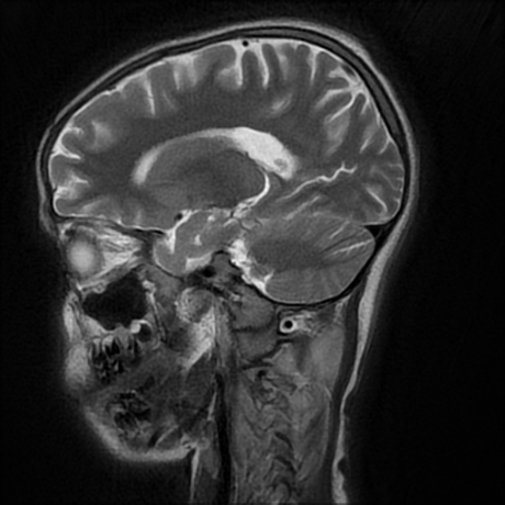 File:Cerebral and spinal tuberculosis (Radiopaedia 90489-107837 Sagittal T2 14).jpg