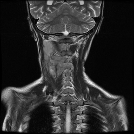 File:Cerebral and spinal tuberculosis (Radiopaedia 90489-107838 Coronal 5).jpg