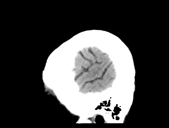 File:Cerebral aneurysm with rupture (Radiopaedia 29933-30457 B 27).jpg