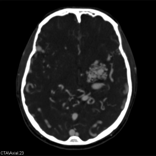 Cerebral arteriovenous malformation (Radiopaedia 28518-28759 B 23).jpg