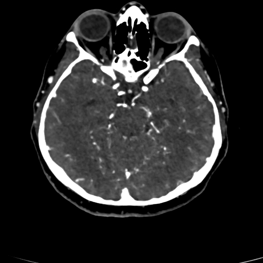 Cerebral arteriovenous malformation (Radiopaedia 73830-84645 Axial C+ delayed 59).jpg