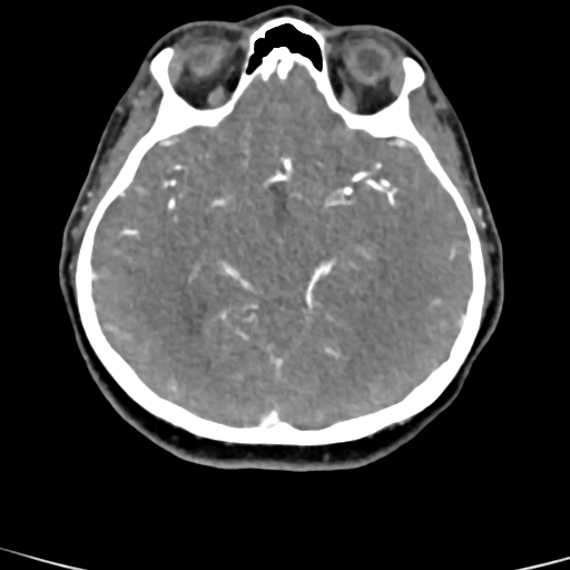 Cerebral arteriovenous malformation (Radiopaedia 73830-84645 B 57).jpg