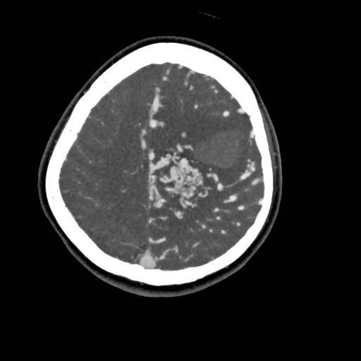 File:Cerebral arteriovenous malformation (Radiopaedia 79677-92888 A 45).jpg