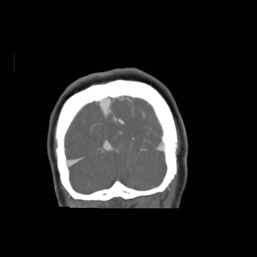 File:Cerebral arteriovenous malformation (Radiopaedia 79677-92888 B 44).jpg