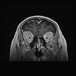 Cerebral arteriovenous malformation (Radiopaedia 84015-99245 Coronal T1 C+ 34).jpg