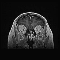 Cerebral arteriovenous malformation (Radiopaedia 84015-99245 Coronal T1 C+ 35).jpg