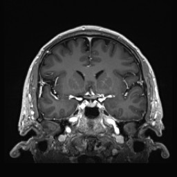 Cerebral arteriovenous malformation (Radiopaedia 84015-99245 Coronal T1 C+ 66).jpg