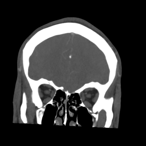 File:Cerebral arteriovenous malformation (Spetzler-Martin grade 2) (Radiopaedia 41262-44076 F 15).png