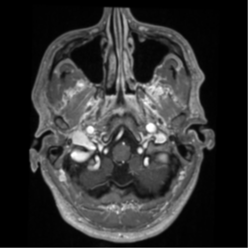 Cerebral arteriovenous malformation - huge (Radiopaedia 35734-37272 Axial T1 C+ 7).png