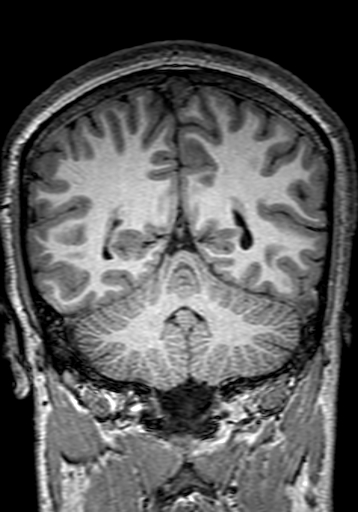 Cerebral arteriovenous malformation at posterior body of corpus callosum (Radiopaedia 74111-84925 Coronal T1 243).jpg