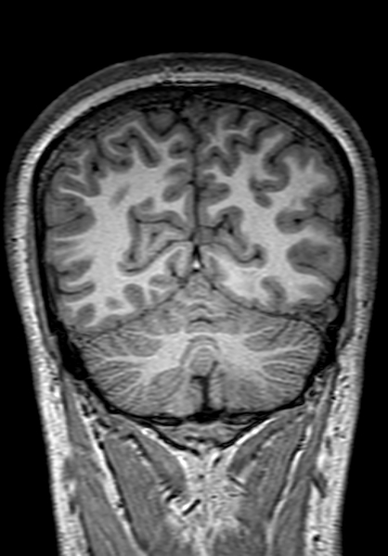 Cerebral arteriovenous malformation at posterior body of corpus callosum (Radiopaedia 74111-84925 Coronal T1 272).jpg