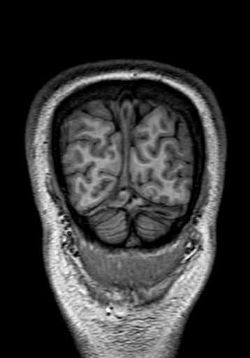 File:Cerebral arteriovenous malformation at posterior body of corpus callosum (Radiopaedia 74111-84925 Coronal T1 325).jpg