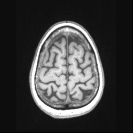 File:Cerebral arteriovenous malformation with hemorrhage (Radiopaedia 34422-35737 Axial T1 65).png