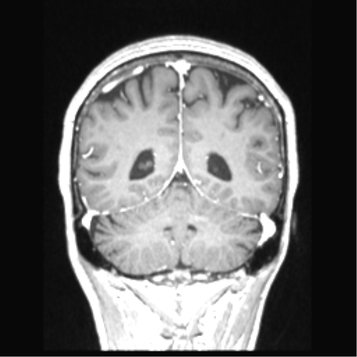Cerebral arteriovenous malformation with hemorrhage (Radiopaedia 34422-35737 Coronal T1 C+ 29).png