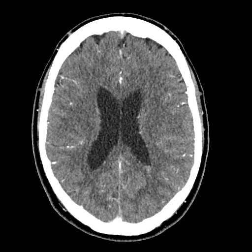 Cerebral arteriovenous malformation with lobar hemorrhage (Radiopaedia 35598-57216 A 38).jpg