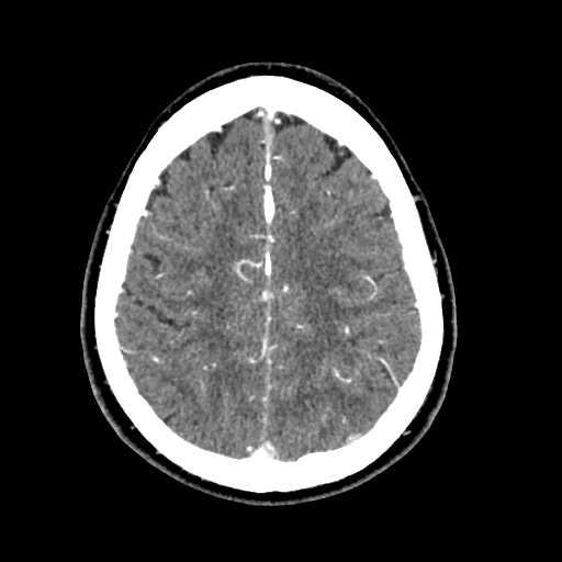 Cerebral arteriovenous malformation with lobar hemorrhage (Radiopaedia 35598-57216 A 48).jpg