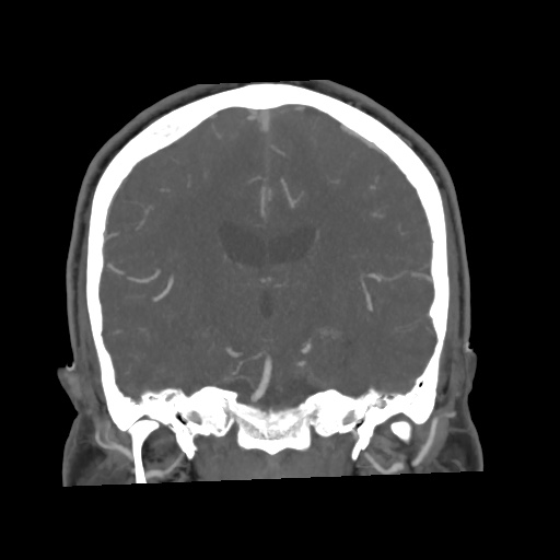 Cerebral arteriovenous malformation with lobar hemorrhage (Radiopaedia 35598-57216 C 50).jpg