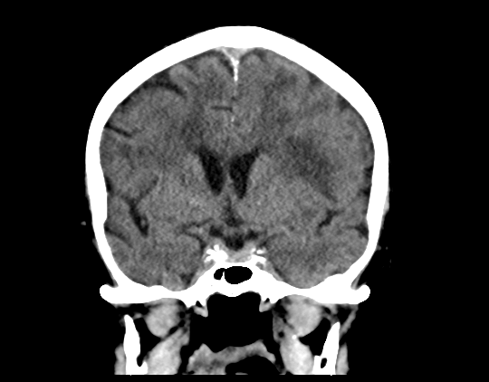 Cerebral arteriovenous malformation with lobar hemorrhage (Radiopaedia 44725-48510 Coronal non-contrast 23).png