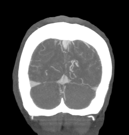 Cerebral arteriovenous malformation with lobar hemorrhage (Radiopaedia 44725-48511 B 50).png