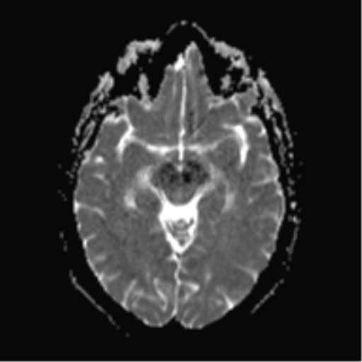 File:Cerebral cavernoma and development venous anomaly (Radiopaedia 37603-39482 Axial ADC 10).png