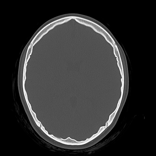 Cerebral cavernous venous malformation (Radiopaedia 70008-80022 Axial bone window 28).jpg
