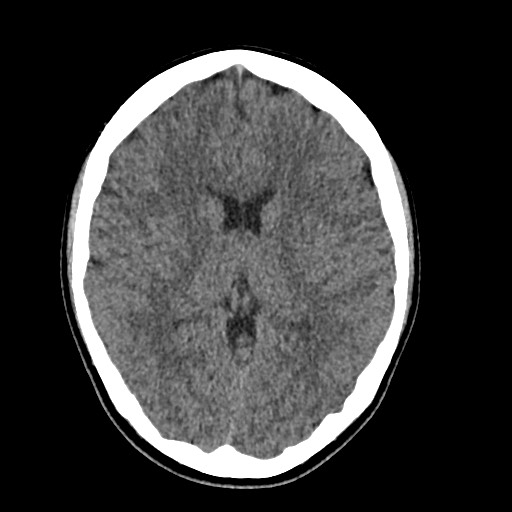 Cerebral cavernous venous malformation (Radiopaedia 70008-80022 Axial non-contrast 27).jpg