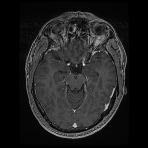 Cerebral cavernous venous malformation (Zabramski type II) (Radiopaedia 85511-101198 Axial T1 C+ fat sat 53).jpg