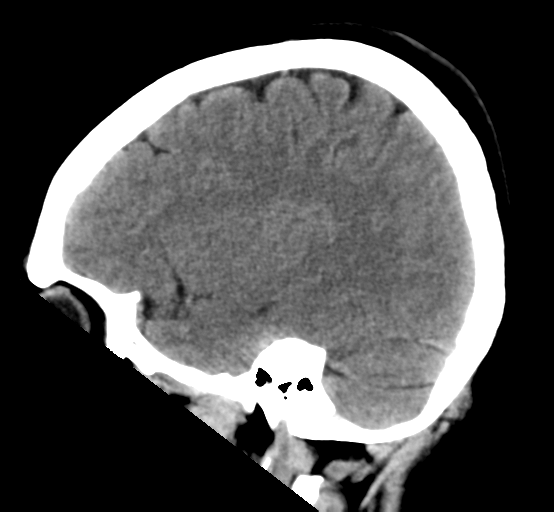 File:Cerebral cavernous venous malformations (Radiopaedia 48117-52945 C 10).png