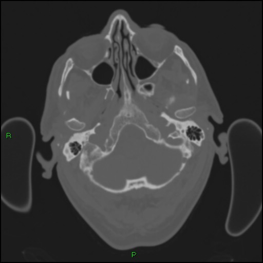 Cerebral contusions (Radiopaedia 33868-35039 Axial bone window 23).jpg