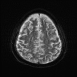 File:Cerebral embolic infarcts (embolic shower) (Radiopaedia 72391-82921 Axial DWI 23).jpg