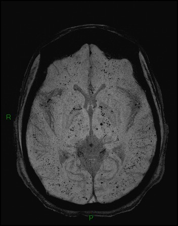 Cerebral fat embolism (Radiopaedia 35022-36525 Axial SWI 15).jpg