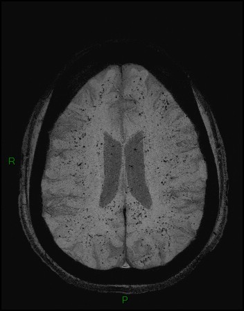 Cerebral fat embolism (Radiopaedia 35022-36525 Axial SWI 33).jpg