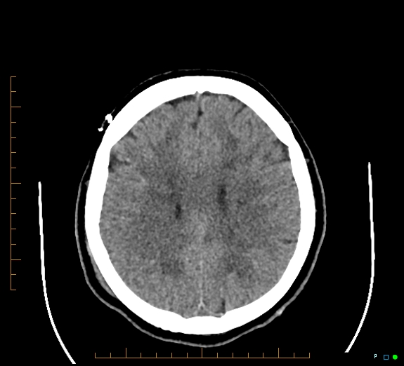 Cerebral fat embolism (Radiopaedia 85521-101220 Axial non-contrast 42).jpg