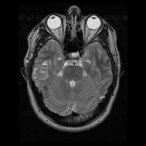 File:Cerebral hemorrhage secondary to arteriovenous malformation (Radiopaedia 33497-34572 Axial T2 8).png