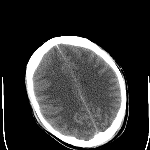 File:Cerebral hemorrhagic contusions- temporal evolution (Radiopaedia 40224-42752 Axial non-contrast 19).png