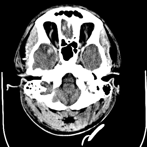 File:Cerebral hemorrhagic contusions- temporal evolution (Radiopaedia 40224-42755 AXIAL THICK 5).png