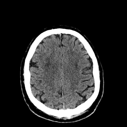 File:Cerebral hemorrhagic contusions and cervical spine fractures (Radiopaedia 32865-33841 Axial non-contrast 26).jpg