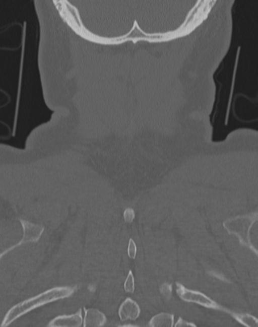 Cerebral hemorrhagic contusions and cervical spine fractures (Radiopaedia 32865-33841 Coronal bone window 71).jpg