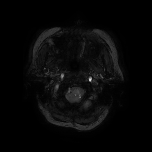 Cerebral metastases - melanoma (Radiopaedia 80972-94522 Axial SWI 7).jpg