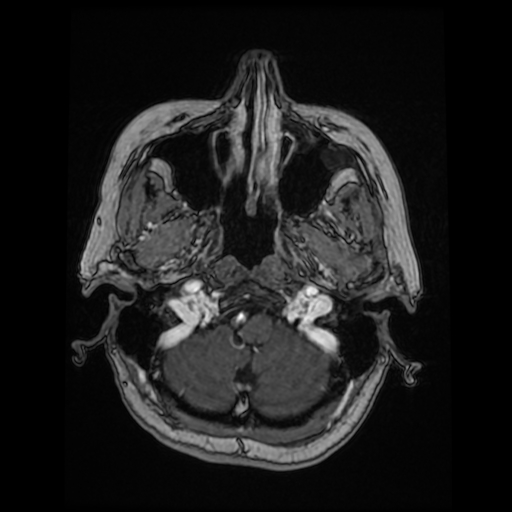 Cerebral metastases - melanoma (Radiopaedia 80972-94522 Axial T1 C+ 28).jpg
