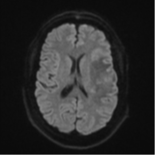 Cerebral metastases mimicking multifocal glioblastoma (Radiopaedia 50843-56353 Axial DWI 44).png