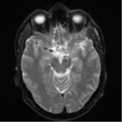 Cerebral metastasis - colorectal adenocarcinoma (Radiopaedia 50394-55765 Axial DWI 10).png