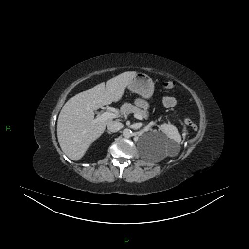 Cerebral metastasis from renal cell carcinoma (Radiopaedia 82306-96378 A 58).jpg