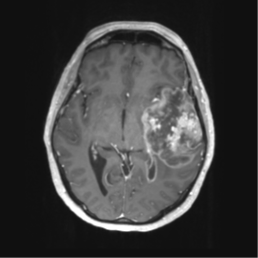 Cerebral metastasis mimicking glioblastoma (Radiopaedia 69155-78937 Axial T1 C+ 29).png
