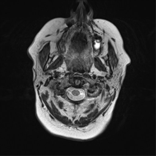 File:Cerebral metastasis mimicking glioblastoma (Radiopaedia 69155-78937 Axial T2 1).png