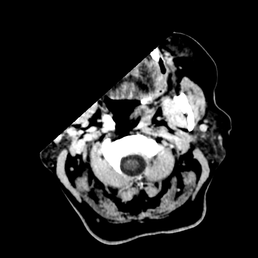 File:Cerebral metastasis to basal ganglia (Radiopaedia 81568-95412 Axial C+ delayed 3).png