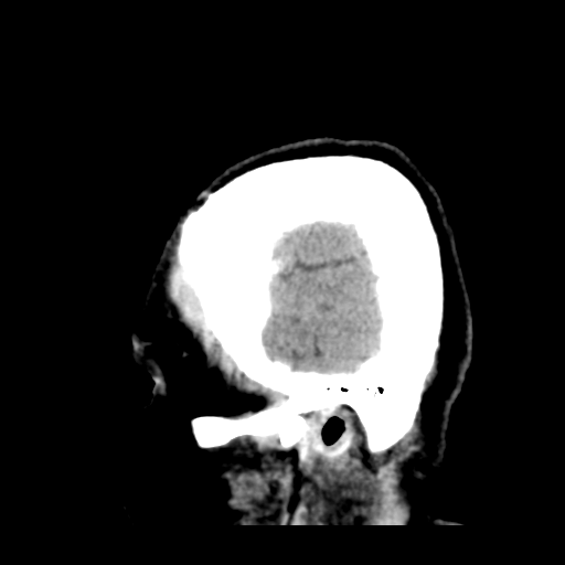 File:Cerebral metastasis to basal ganglia (Radiopaedia 81568-95412 Sagittal C+ delayed 50).png