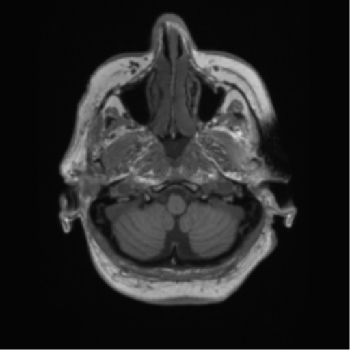 Cerebral metastasis to basal ganglia (Radiopaedia 81568-95413 Axial T1 7).png